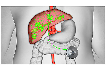 Hepatic Artery Infusion 