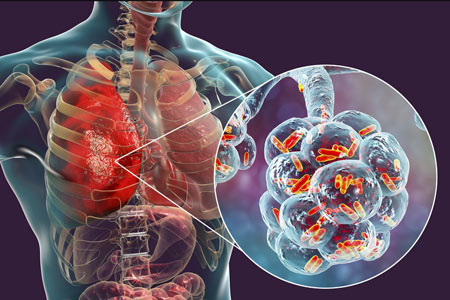 Legionnaires' disease