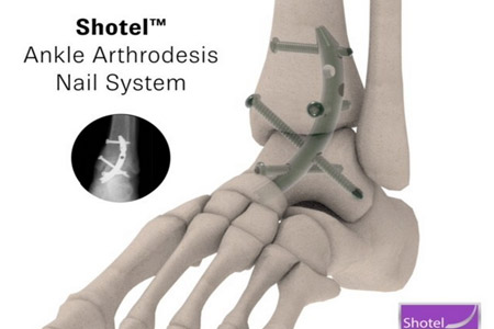 Shotel Ankle Arthrodesis Nail System Enhances Healing
