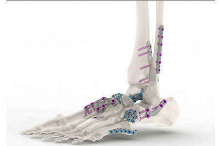 Tyber Medical Anatomical Plating System