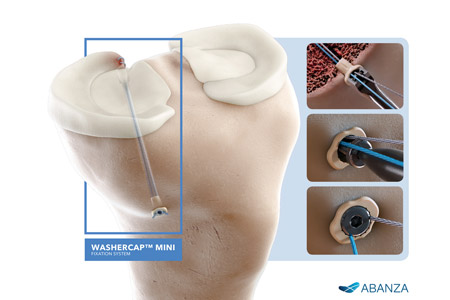 ABANZA's New WasherCap™ Mini