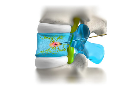 Basivertebralis Nerve Ablation (BVNA) 