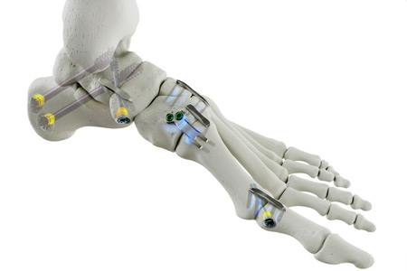 Medline UNITE's REFLEX® HYBRID Nitinol Implant System 