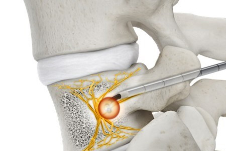 OptaBlate BVN ablation in vertebral body 