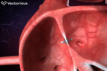 V-LAP Left Atrial Pressure Sensor