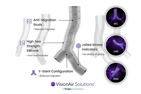 VisionAir Solutions Custom Airway Stents. 