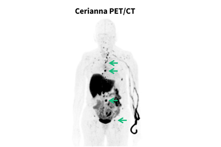 PET/CT scan with Cerianna™